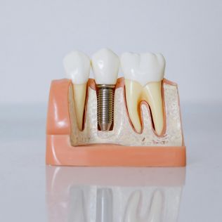 Implantes