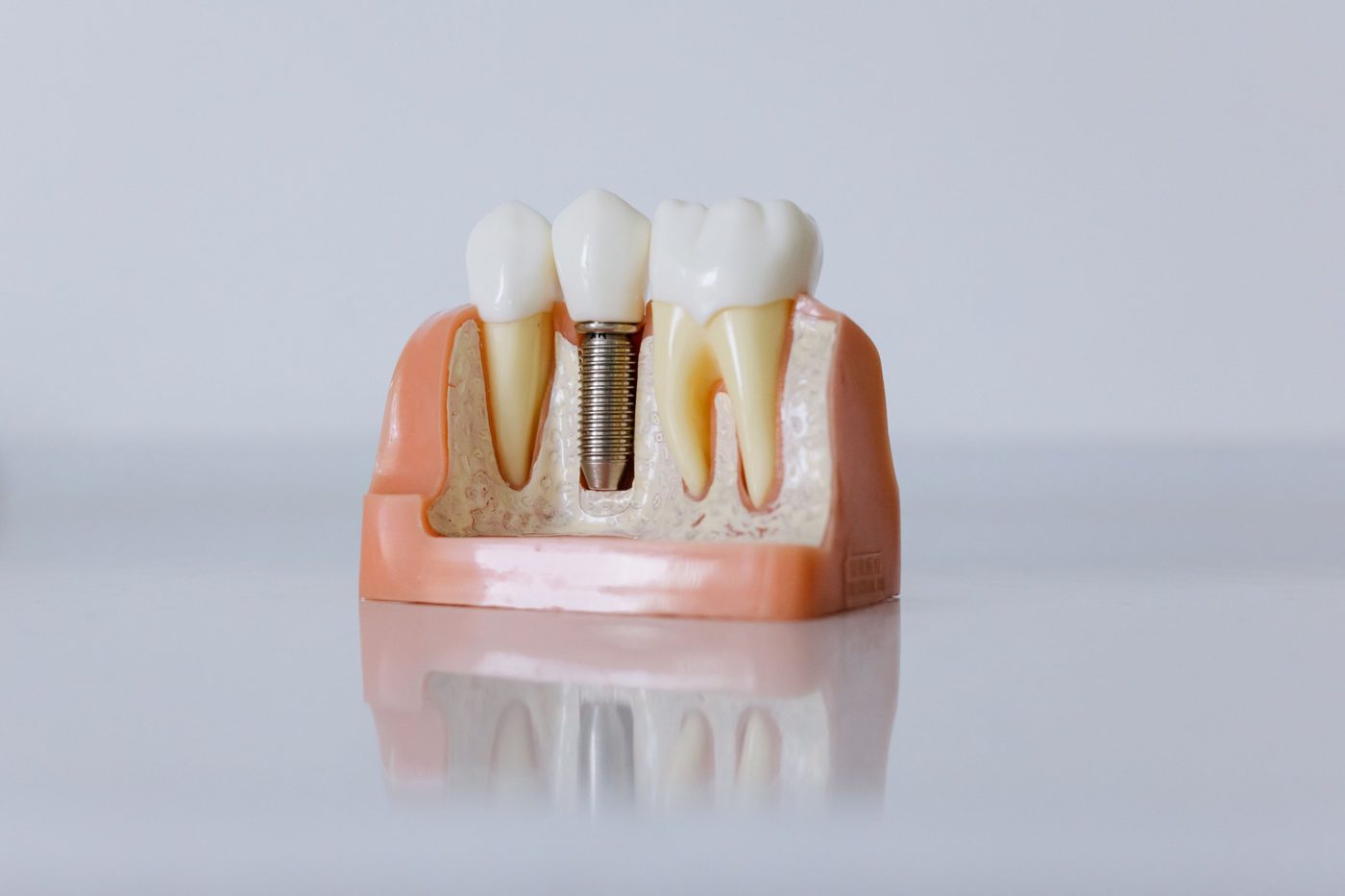 Modelo de implante dental con corona entre dos dientes