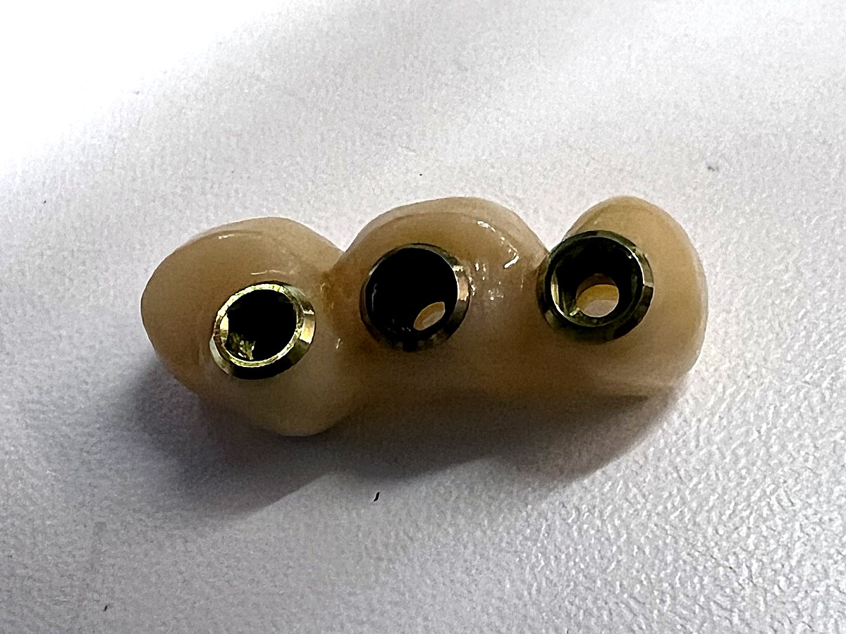 Puente dental atornillado sobre tres implantes, con los orificios de acceso a los tornillos