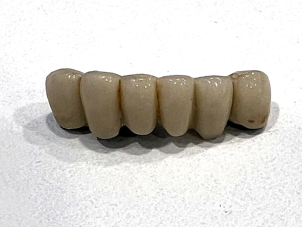 Puente dental fijo de seis piezas