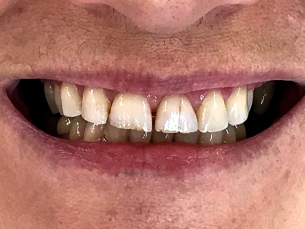 Sonrisa antes de las carillas