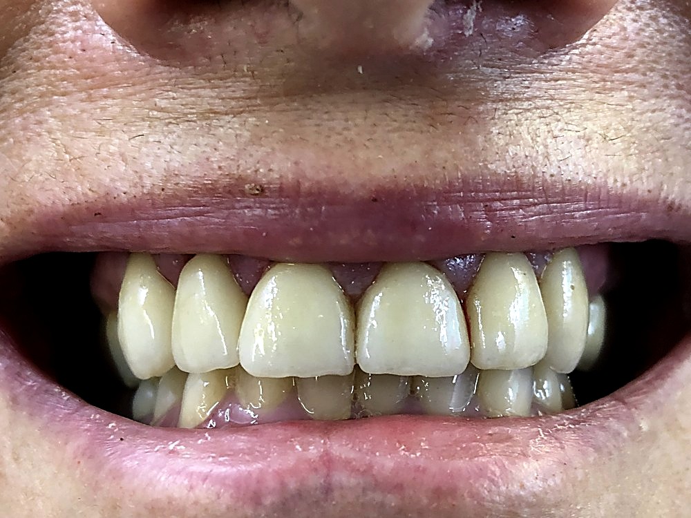 Sonrisa con las carillas colocadas