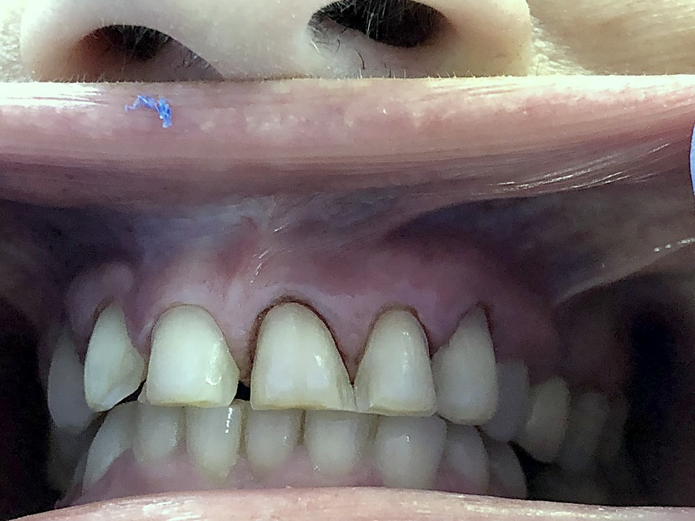 Dientes tallados para colocar carillas