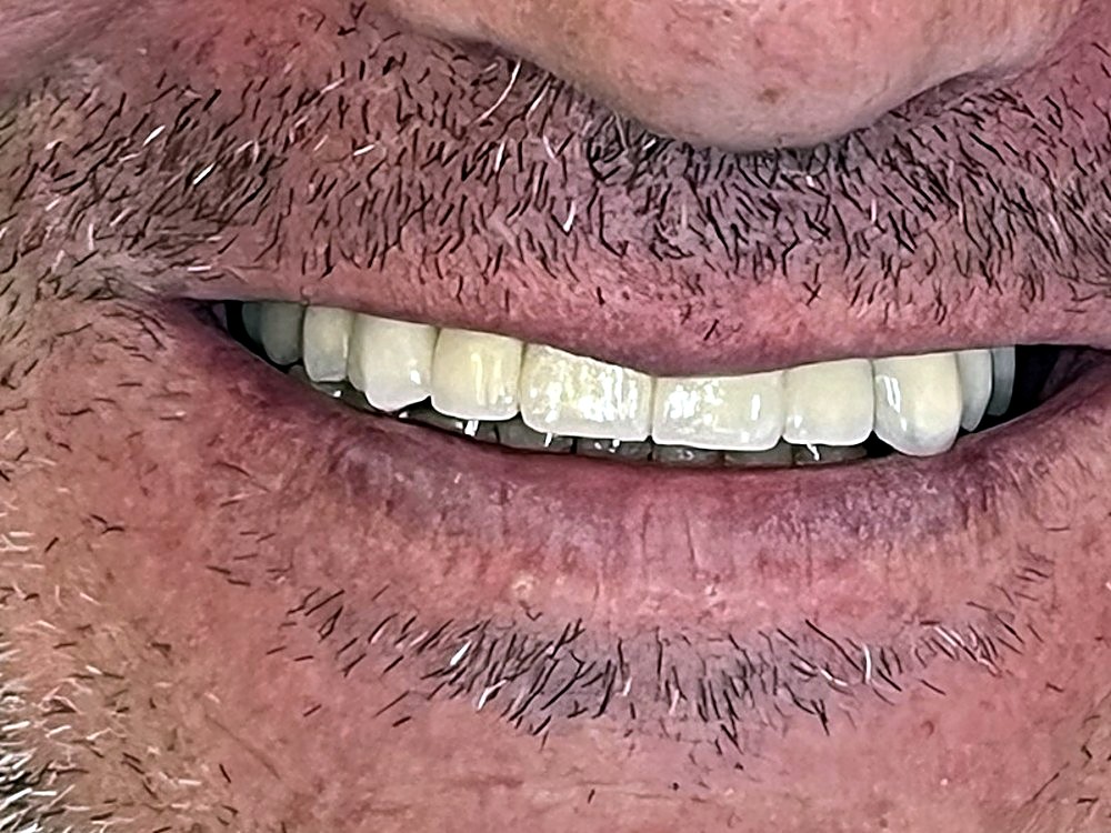 Sonrisa con un puente fijo superior colocado