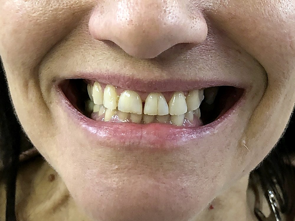 Sonrisa antes del tratamiento estético