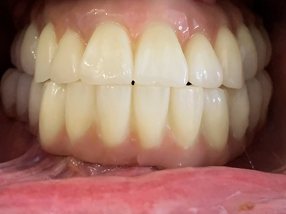 Sonrisa con la rehabilitación completa sobre implantes