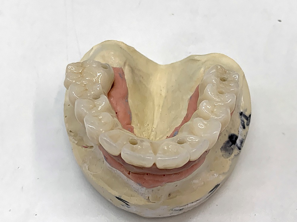 Prótesis sobre el modelo con los implantes, vista desde arriba