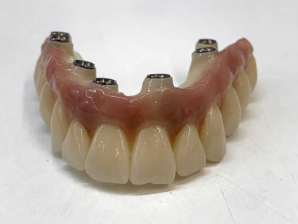 Prótesis fija sobre implantes antes de colocarla